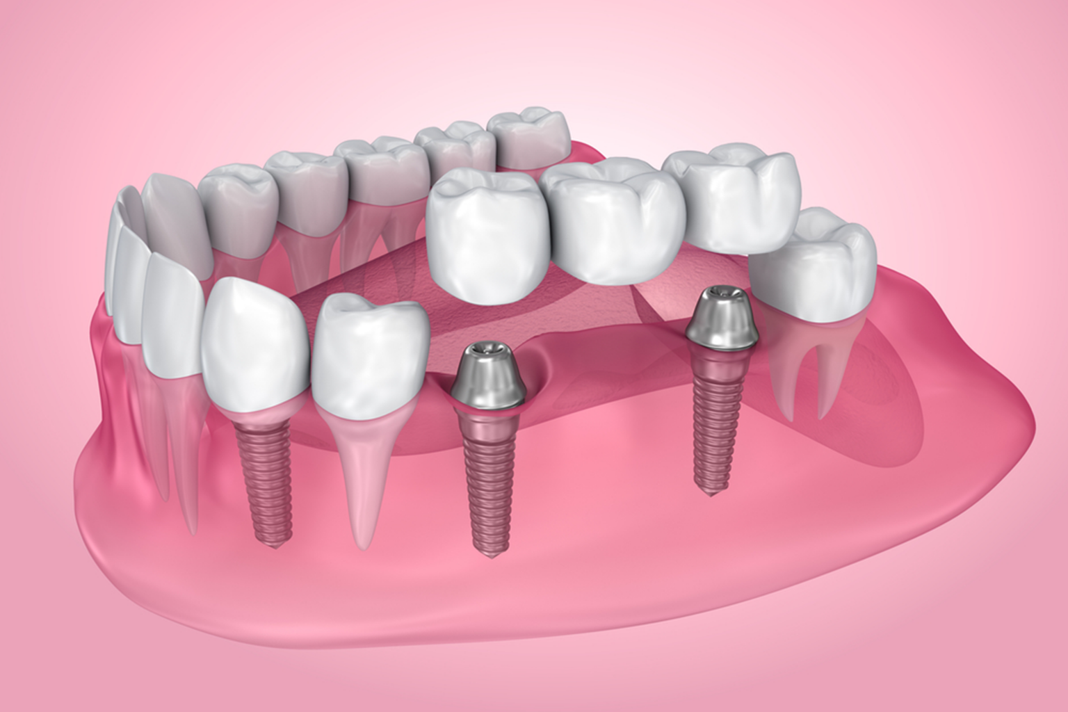 dental Bridges