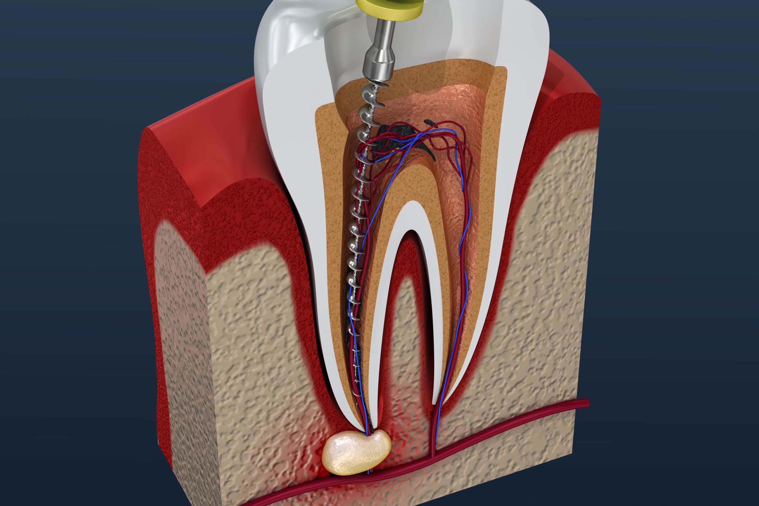 Root-Canals